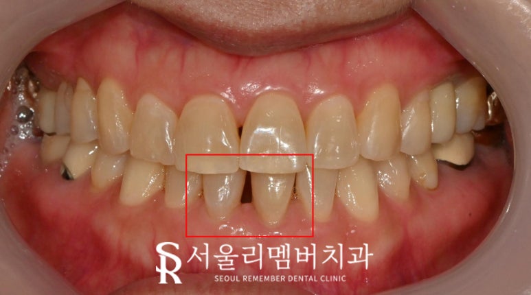 윗니 말고 아랫니! 사당 치과 아래 앞니 하악 전치 벌어진 공간 레진 다이아스태마(Diastema) 관련 이미지 2