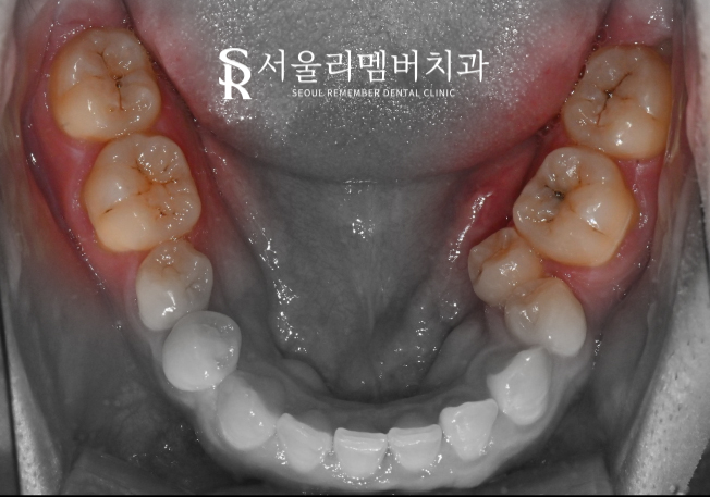 어금니에 까만 점이 있어요.. 충치치료를 받아야 되나요? 봉천역 치과 관련 이미지 2
