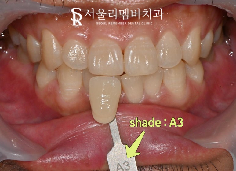미백 후 이 시림 걱정이신가요? 무리 가지 않는 서울대입구역 치과 전문가 치아미백 과정 관련 이미지 1
