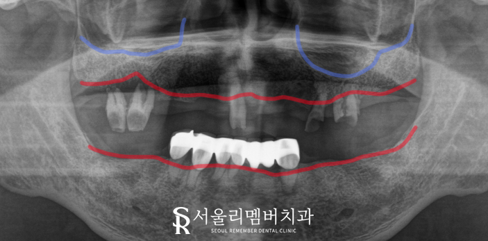 앞니 송곳니 어금니 윗니 전체 임플란트 성공 케이스 "서울대입구역 치과" 관련 이미지 2