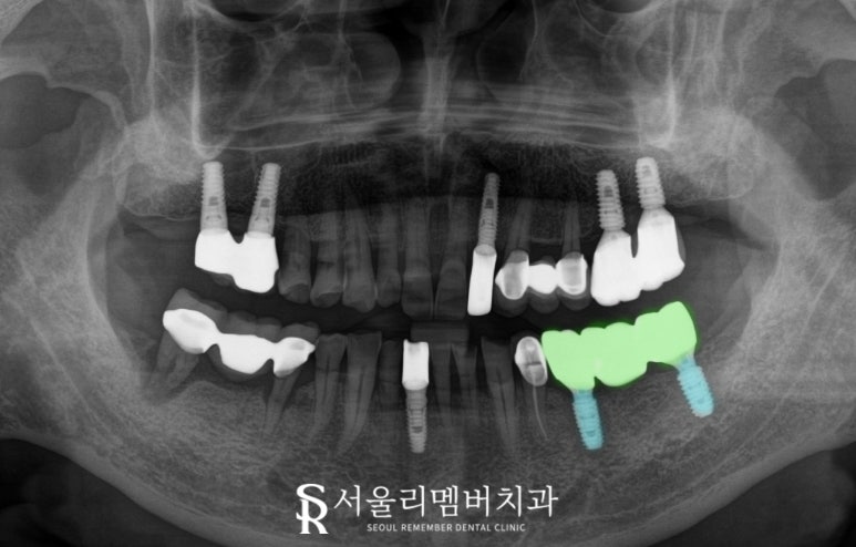 왼쪽 아래 어금니 임플란트 브릿지 장점, 진행 과정, 빨리 치료해야 되는 이유 상도동 치과 관련 이미지 4