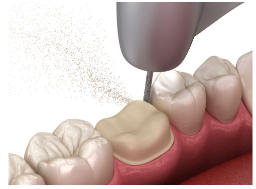 신대방 치과, 깨지고 충치가 심한 앞니 심미 크라운 수복한 증례 관련 이미지 3