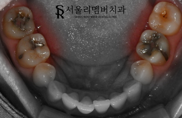 숭실대입구역 치과 에서 이차우식이 생긴 오래된 인레이를 새하얗게 개선해 드렸습니다. 관련 이미지 2