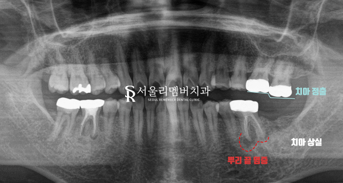 어금니 상실로 인한 치아 정출 낙성대역 치과 임플란트 및 신경치료 증례 관련 이미지 1
