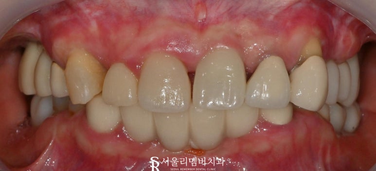 잇몸뼈 소실 다수의 치아 서울대입구역 치과 에서 전체 임플란트 브릿지 수술 진행 관련 이미지 1