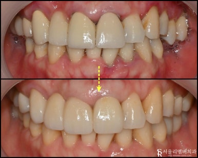 낙성대 치과 "어금니가 없어요." 가이드 임플란트와 신경치료 과정 관련 이미지 6