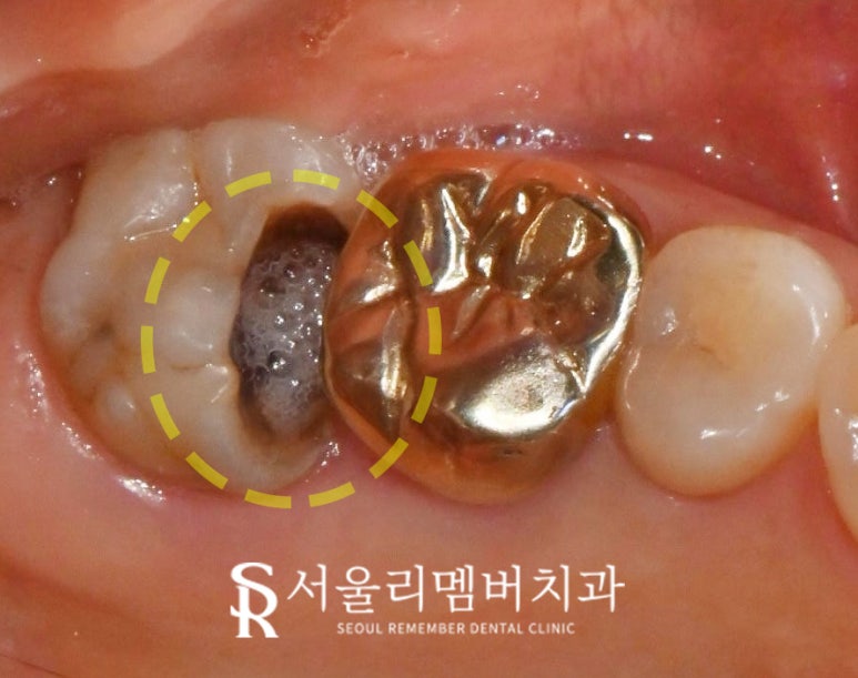 살리려던 어금니, 신경치료 시도 후 결국 임플란트로 복구한 보라매 치과 치료 사례 관련 이미지 2