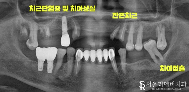 빠져버린 치아 그대로 내버려 두면 안모변형을 초래할 수 있습니다! 신림역 서울 리멤버 치과 관련 이미지 4