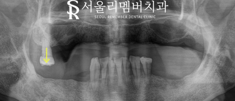 사당 치과, 틀니 대신 전체 임플란트로 새로운 구강 환경 되찾아 드린 사례 관련 이미지 2