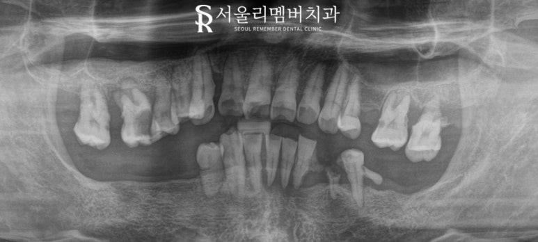 무너진 구강 환경 서울대입구역 치과 에서 편하게 전체 임플란트 치료한 사례 관련 이미지 4