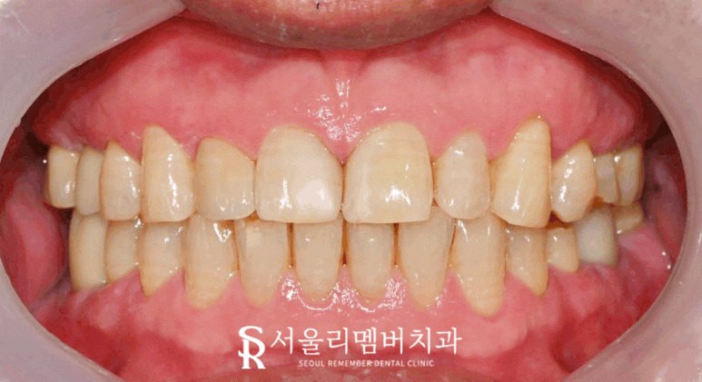 겨울철 넘어짐으로 파절된 앞니 신림 치과 당일 레진 충전 케이스 관련 이미지 2