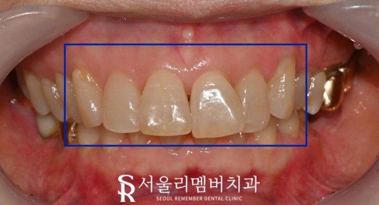 앞니 크라운, 무삭제 리얼네이트로 치열 및 톤 개선 신림 치과 최소삭제 라미네이트 당일 치료 관련 이미지 2