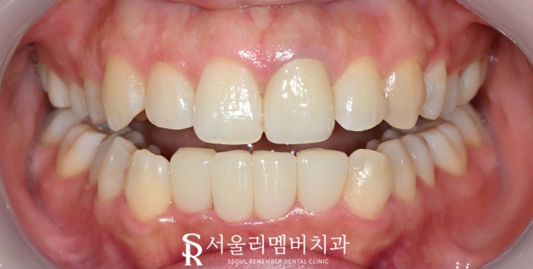 교정이 부담스러운데 치아 삐뚤빼뚤 총생 있다면 봉천역 치과 전치부 리얼네이트와 앞니 크라운 관련 이미지 4