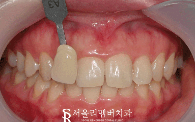 "하얀 치아를 갖고 싶어요!" 신대방 치과 에서 치아미백 받아보세요. 관련 이미지 4