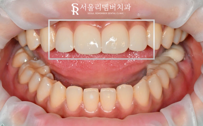 앞니 벌어짐, 레진 말고 라미네이트로 사이 틈새 자연스럽게 채우자 서울대입구 치과 상악 전치부 리얼네이트 케이스 관련 이미지 6