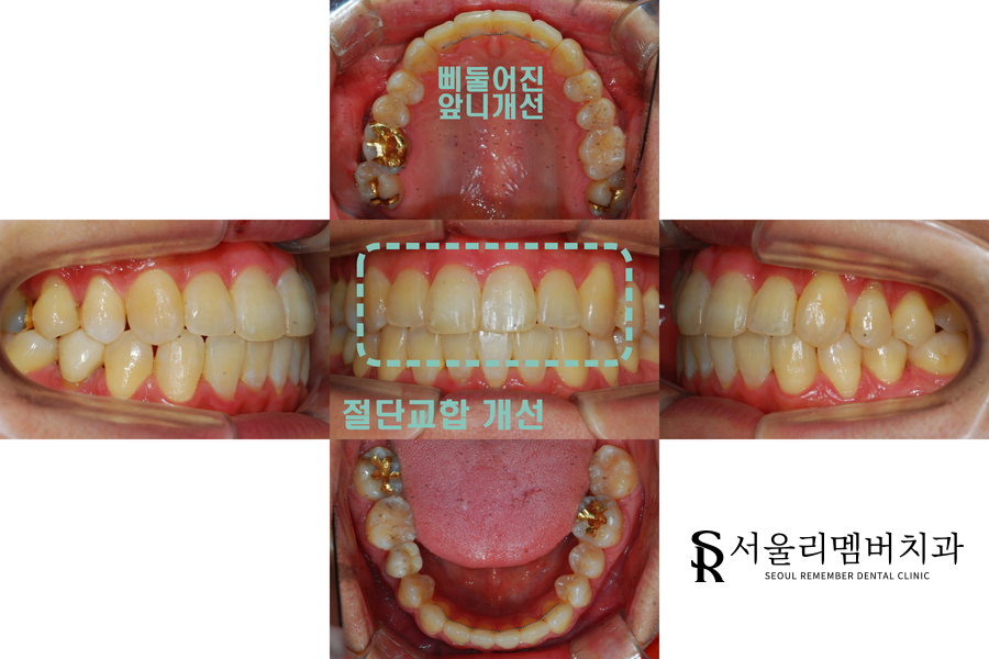 절단 교합 (edge to edge)이 나타난 치아, 봉천동 치과 인비절라인 교정 증례 관련 이미지 2