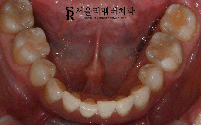숭실대입구역 치과 에서 이차우식이 생긴 오래된 인레이를 새하얗게 개선해 드렸습니다. 관련 이미지 3