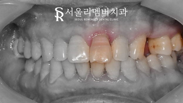 앞니 임플란트 관련 이미지 1