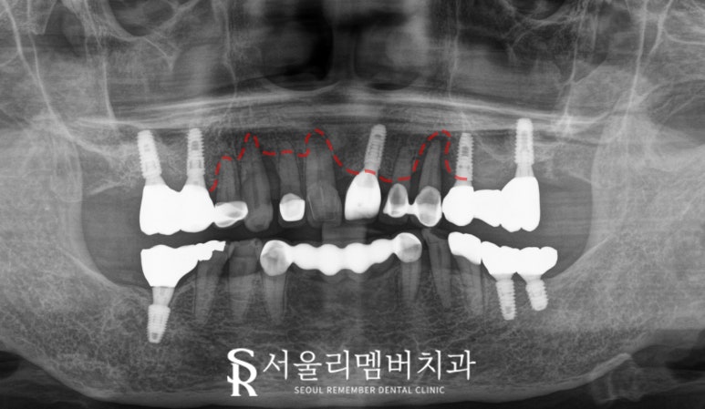 잇몸뼈 소실 다수의 치아 서울대입구역 치과 에서 전체 임플란트 브릿지 수술 진행 관련 이미지 3