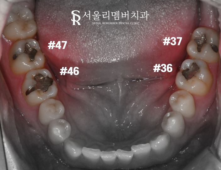 봉천동 치과 에서 썩은 치아, 어금니 인레이로 개선 완료! 관련 이미지 1