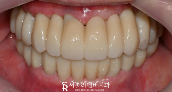 서울대입구역 치과 에서 수면(의식하진정)요법 동반한 전체 임플란트 식립 관련 이미지 6