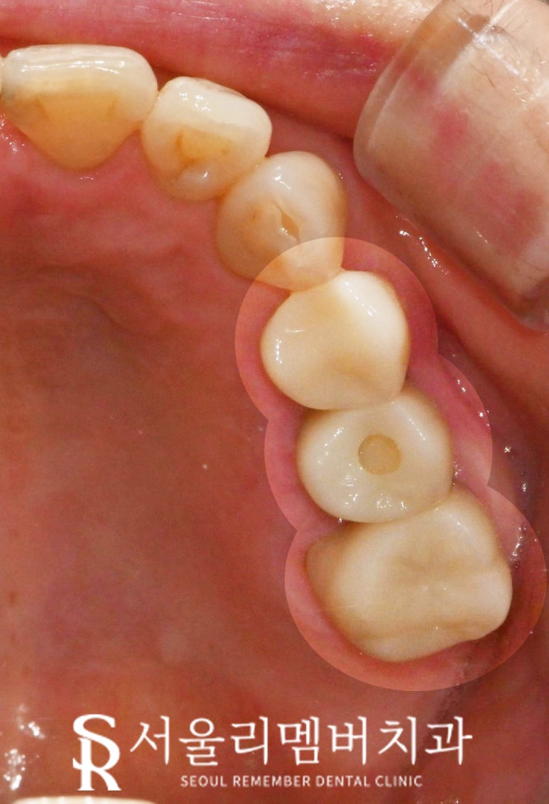 봉천역 치과 어금니 보철 후 음식물 끼임 및 치아 파절, 신경치료 크라운 및 임플란트 관련 이미지 7
