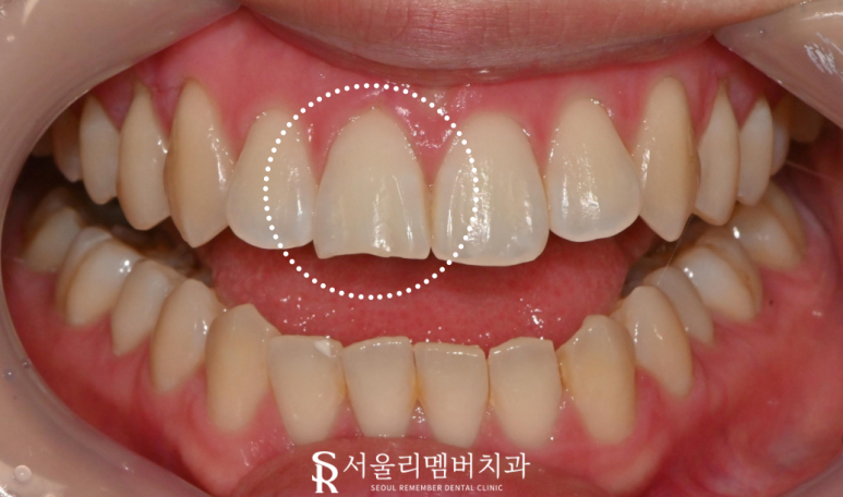 사당역 치과 깨진 앞니, 당일 레진 수복으로 비용 부담 없이 하루 만에 가능 관련 이미지 1