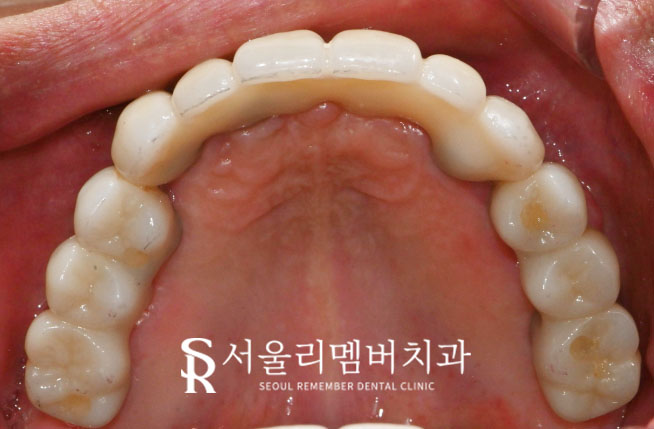 서울대입구역 치과 , 잇몸뼈 부족해도 전체 임플란트 ? 가능합니다. <증례 有> 관련 이미지 5