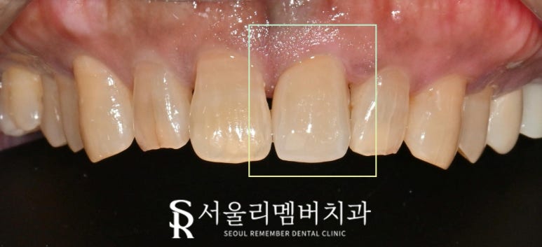 앞니가 깨졌다면? 상도동 치과 신경치료 없이 크라운만으로 자연치아 살리기 관련 이미지 4