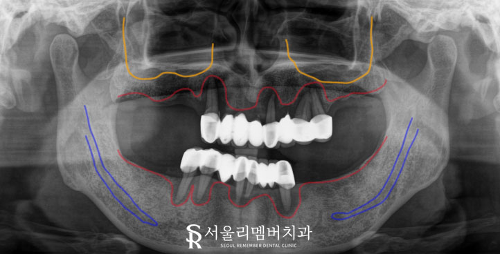서울대입구역 치과 , 잇몸뼈 부족해도 전체 임플란트 ? 가능합니다. <증례 有> 관련 이미지 3