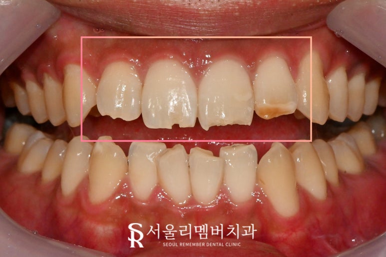 봉천동 치과 위 앞니 상악 4전치 파절 레진 당일 치료 과정, 비용, 견적, 시간 관련 이미지 1
