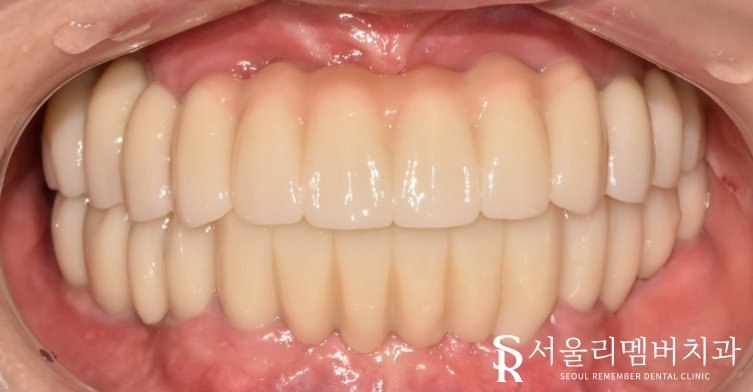 빠져버린 치아 그대로 내버려 두면 안모변형을 초래할 수 있습니다! 신림역 서울 리멤버 치과 관련 이미지 10