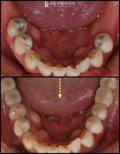 낙성대 치과 "어금니가 없어요." 가이드 임플란트와 신경치료 과정 관련 이미지 7