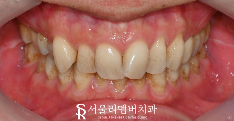 신림역 치과 스케일링 치석제거로 착색과 변색 해결하면 치아미백 만큼 하애질 수 있을까? 관련 이미지 2