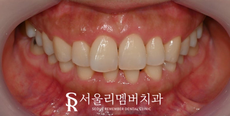 낙성대 치과 앞니 틀어짐 하악 전치 측절치 결손 라미네이트로 공간 닫기 성공 관련 이미지 4