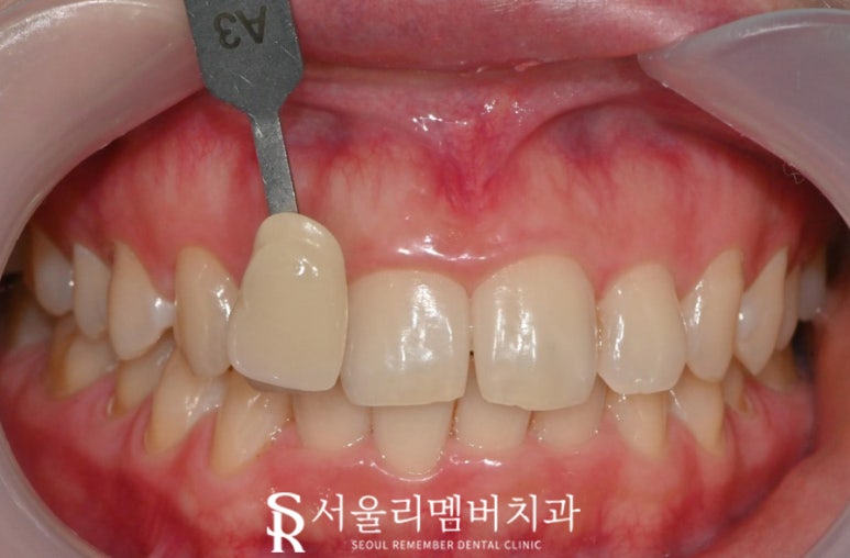 "하얀 치아를 갖고 싶어요!" 신대방 치과 에서 치아미백 받아보세요. 관련 이미지 1