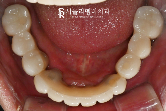 서울대입구역 양심 치과, 최소 비용으로 전체 임플란트 수술 관련 이미지 7