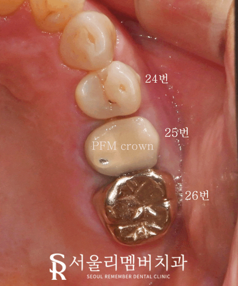봉천역 치과 어금니 보철 후 음식물 끼임 및 치아 파절, 신경치료 크라운 및 임플란트 관련 이미지 1