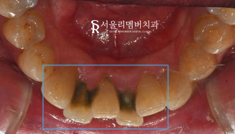 서울대입구역 치과 에서 알려드리는 스케일링의 모든 것-! 관련 이미지 2