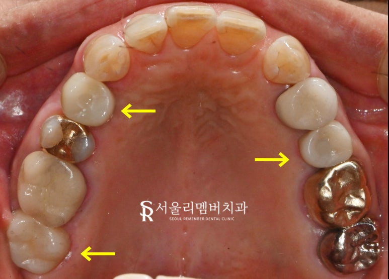 치아 곳곳에서 생긴 문제, 사당 치과 임플란트 및 크라운 치료 관련 이미지 7