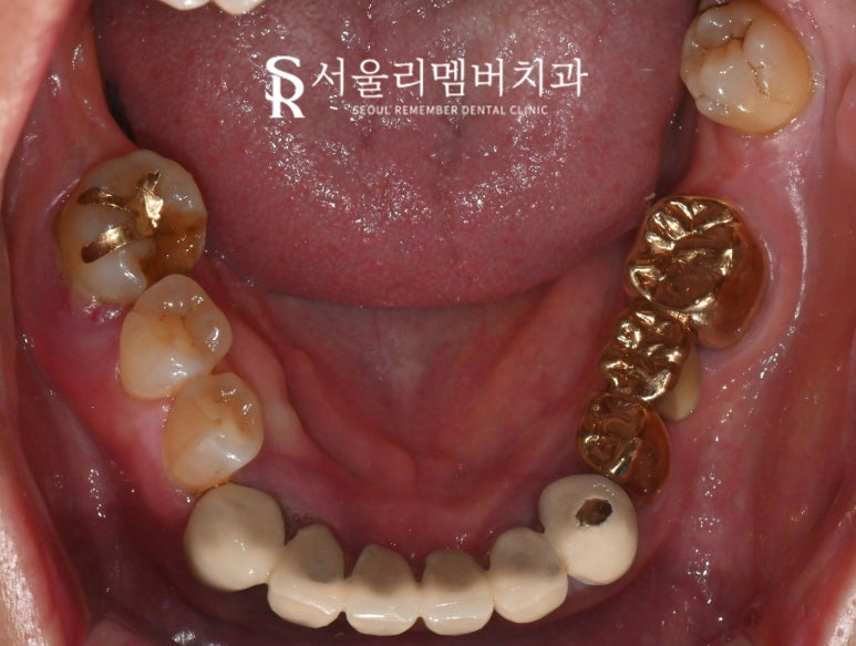 "잇몸에 고름이 차고 흔들려요!" 서울대입구 임플란트 디지털 진료로 치료한 사례 관련 이미지 2