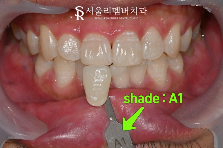미백 후 이 시림 걱정이신가요? 무리 가지 않는 서울대입구역 치과 전문가 치아미백 과정 관련 이미지 3