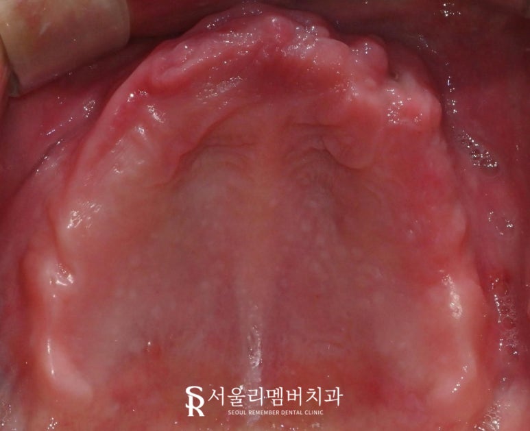 과잉진료 없는 보라매 치과 에서 최소 개수 전악 임플란트 식립 관련 이미지 1