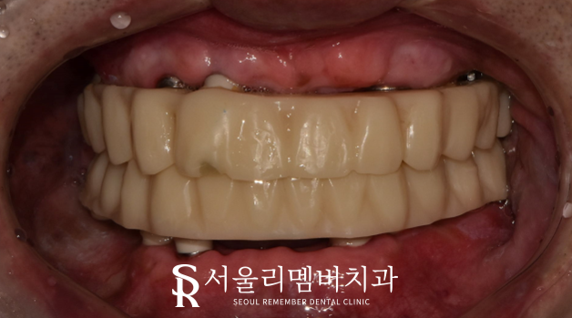 오래된 보철을 방치하면 결국 임플란트 식립밖에 남지 않게 됩니다! 봉천역 리멤버 치과 관련 이미지 7