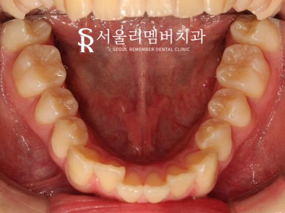 인비절라인을 사용한 치아 총생 개선 증례! 청룡동 치과 관련 이미지 5