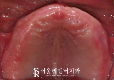 보라매 치과 에서 틀니에서 수면마취 전악 임플란트로 전체 치아 기능 회복 관련 이미지 2