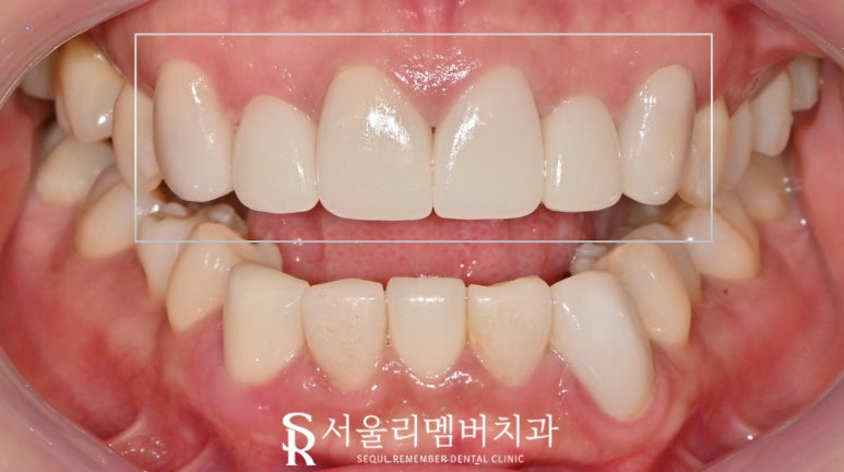 Nakseongdae Dental Clinic: If a front tooth laminate veneer falls off, can’t it just be reattached? Anterior crowns and Realnate re-prosthetics image 6
