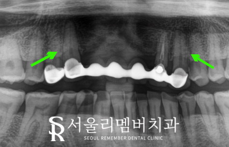 상악 전치부 임플란트 후 고퀄리티 심미보철 로 자신감 되찾으세요! 관련 이미지 1