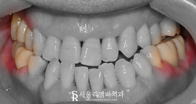 신림역 치과, 어금니 임플란트 및 보철 치료로 심미 저작 기능 개선 과정 관련 이미지 4