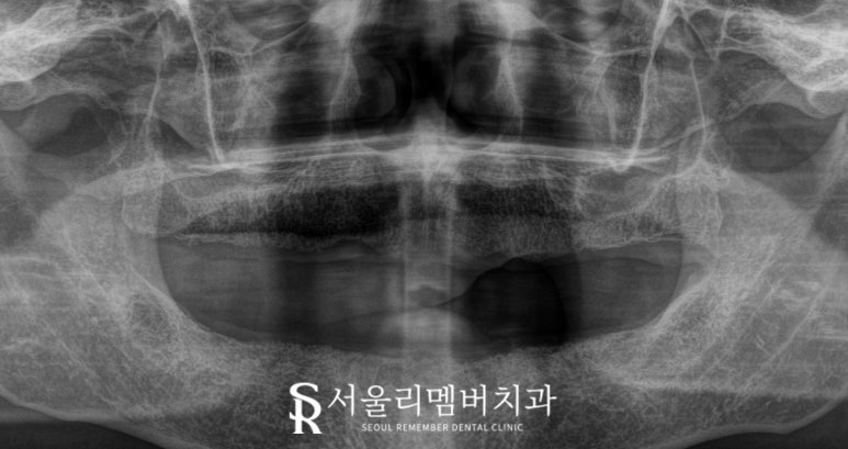 보라매 치과 에서 틀니에서 수면마취 전악 임플란트로 전체 치아 기능 회복 관련 이미지 4